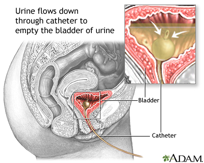catheter image 